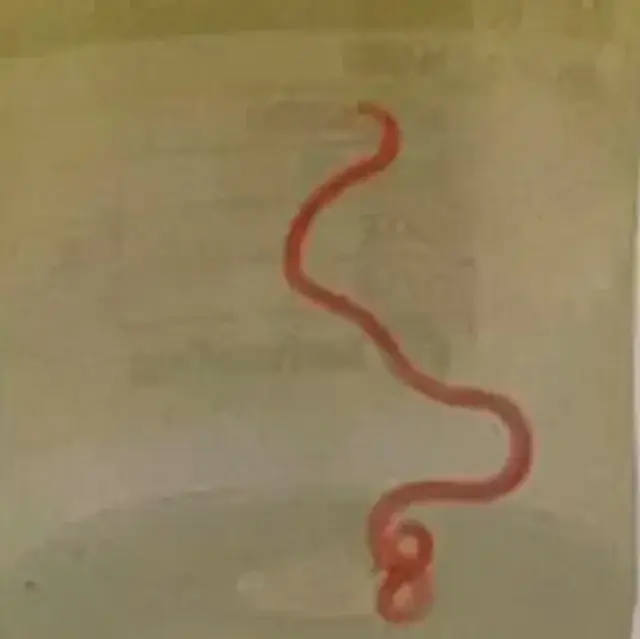В мозгу австралийки нашли живого 8-сантиметрового червя